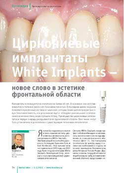 Циркониевые имплантаты White Implants – новое слово в эстетике фронтальной области